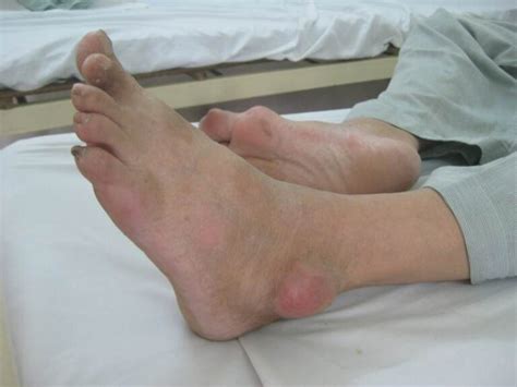 Ankle Gout Pictures Symptoms And Pictures