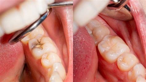 Simak Tips Perawatan Gigi Berlubang Selama Bulan Puasa
