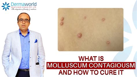 What Is Molluscum Contagiosum Cure For Molluscum Contagiosum Dr Rohit Batra YouTube