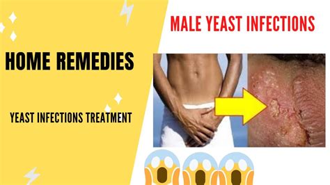 Male Yeast Infection Home Remedies For Yeast Infection Home Remedies For Male Yeast