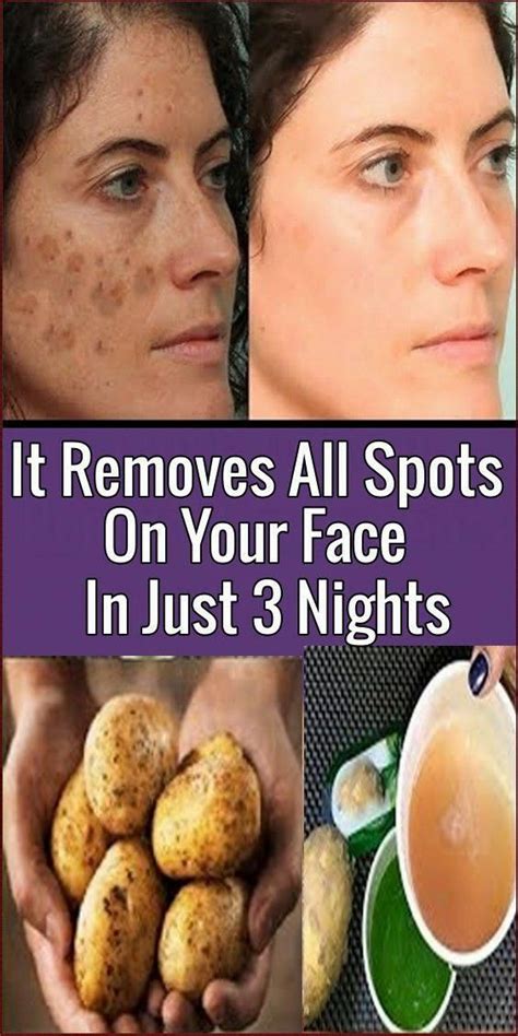 How To Get Rid Of Dark Spots On Experience Right Away Brownagespots Brown Spots On Face