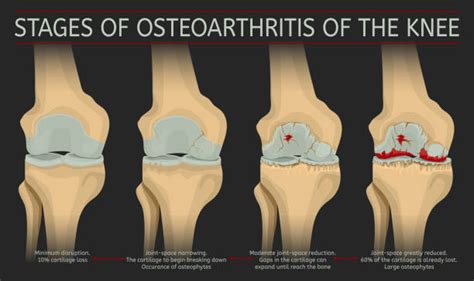 Osteoarthritis Stock Photos Pictures And Royalty Free Images Istock