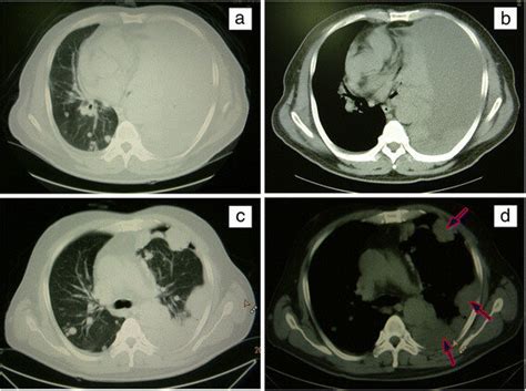 The Chest Ct Imaging Of The Pleural Effusion And Lesions Before