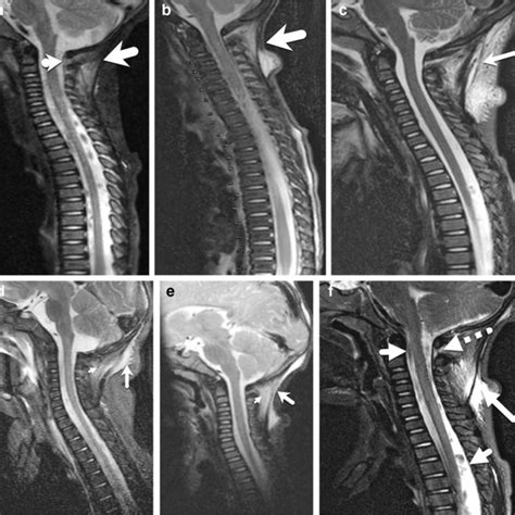 Normal Appearance Of Nuchal Ligament And Suboccipital Region On Mri A