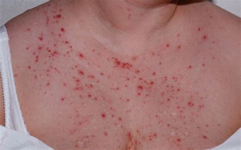 Chest Rash Causes Remedies And Managing Them Skincarederm