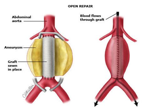 Abdominal And Thoracic Aortic Aneurysms Nq Vascular Services