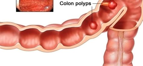 Colon Cancer Stages Early Detection Anatomy System Human Body