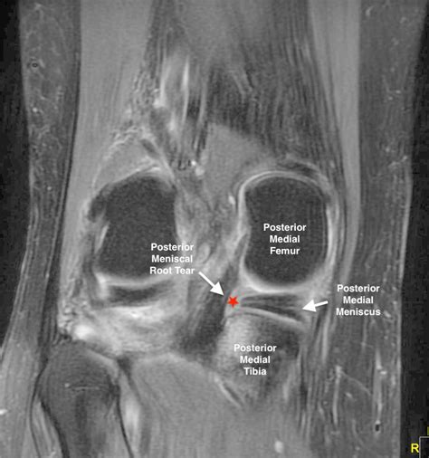 Root Tears Of The Meniscus Video Town Center Orthopaedics