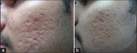 37 Atrophic Acne Scars Types Pics