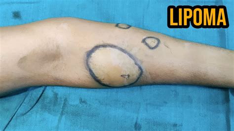 Best Lipoma Treatment Multiple Lipoma Removal From A Patients Arms