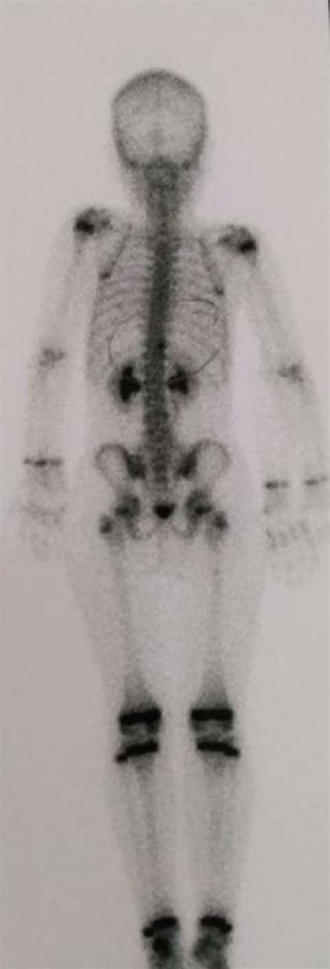 Bone Scintigraphy The Image Shows A Slight Increase In Osteoblastic