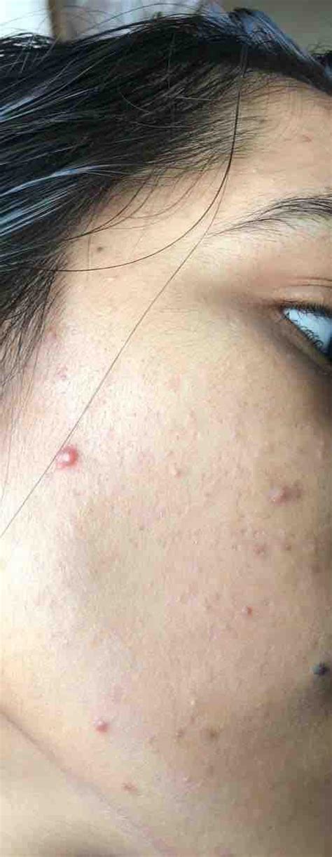 Nodular Cystic Acne