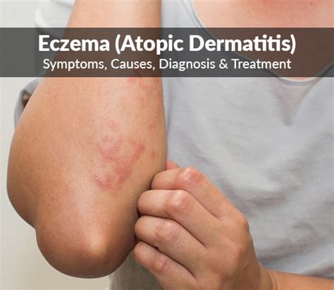 How To Treat Atopic Dermatitis Pdf S2k Guideline On Diagnosis And