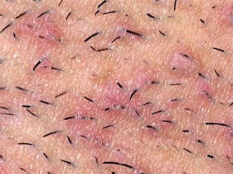 Ingrown Hairs How To Remove And To Remove On Pinterest