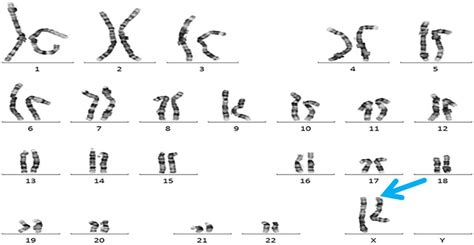 Karyotype Of The Patient Showing Two X Chromosomes And The Absence Of