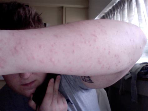 Show Me Bed Bug Bites On Humans Blog About Bed Bugs