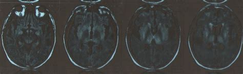 Hypoxic Brain Injury Mri Sumers Radiology Blog