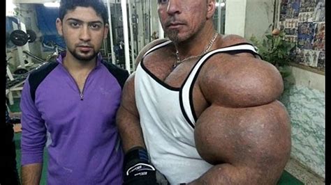 Biggest Synthol Freaks Ever Fails Compilation 2016 Youtube