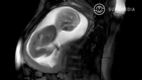 Incredible Mri Footage Of A Baby In The Womb Taken By Ifind Project