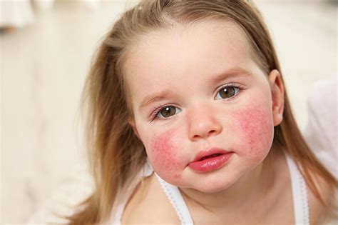 Sollten gerade viele kinder in der schule oder im kindergarten an ringelröteln erkrankt sein, so kann es wann zum arzt wegen ringelröteln? Masern, Mumps, Windpocken & Co.: Typische ...