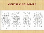 PPT - Maniobras de Leopold y Medición de Fondo Uterino PowerPoint ...