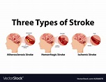 Infographic of common types of stroke Royalty Free Vector