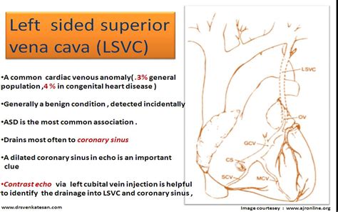 Two Slide Presentation Left Superior Vena Cava Lsvc Drs