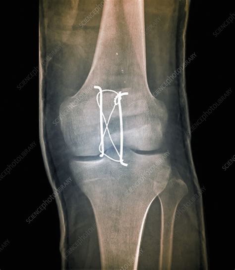 Pinned Kneecap Fracture X Ray Stock Image C0269997 Science