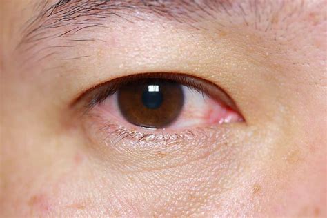 The Most Common Eye Diseases And Treatments Medibuddy