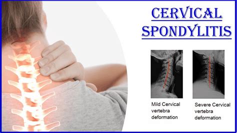 Cervical Spondylosis And Wrist Pain