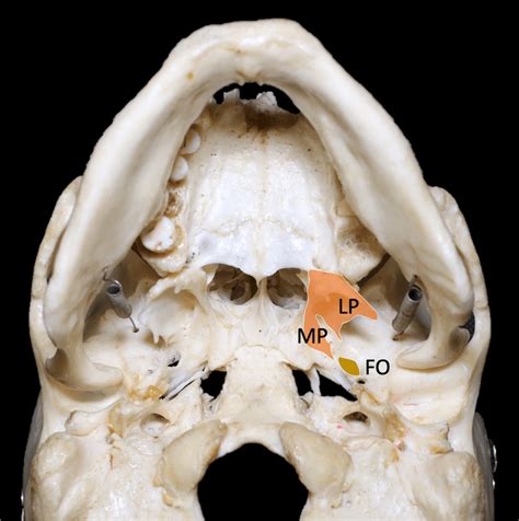 Medial And Lateral Pterygoid Plates