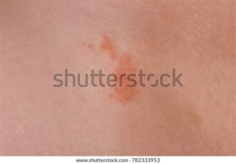 Great Red Spot On Skin Closeup Stock Photo 782333953 Shutterstock