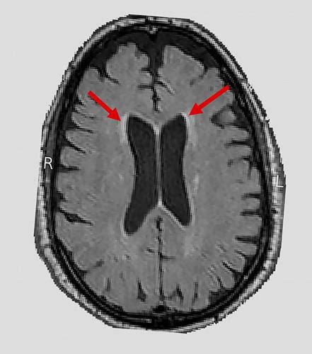 Mri Brain Scans Link High Blood Pressure With White Matter Lesions