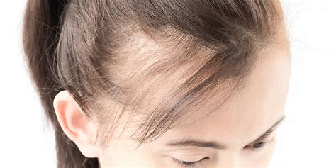 Lupus Hair Loss Causes Symptoms And Treatments