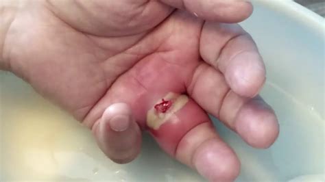 Finger Cyst Pimple Or Boi Healt