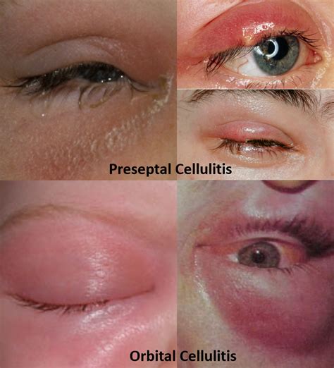 What Is Cellulitis Eye Usefull Information