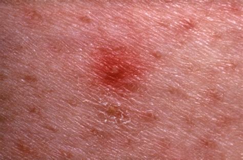 The majority of the time, these break outs are harmless and will clean up on their own. Skin Rash: 7 Causes of Red Spots and Bumps With Pictures ...