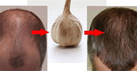 Fortunately, hair loss in women typically does not result in complete baldness, as is often the case with men. Why Garlic May Be the Best Natural Treatment Against Hair ...