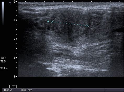 Figure 1 From How Not To Misdiagnose Malignant Thyroid Nodules