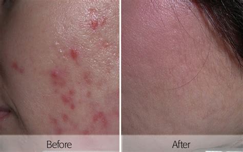 Acne Scars Friedman Dermatology