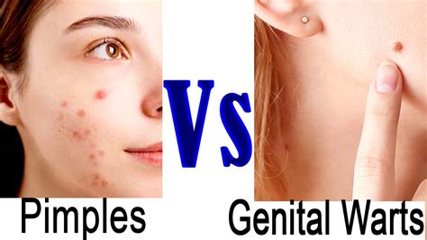 What Is The Difference Between Genital Warts And Pimples