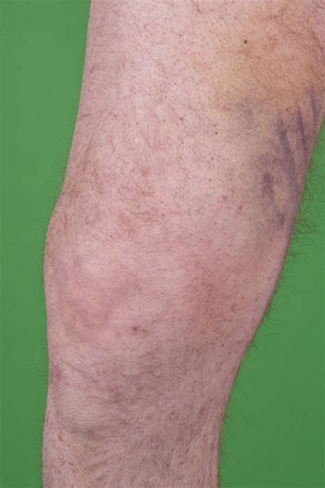 Leg Bruises