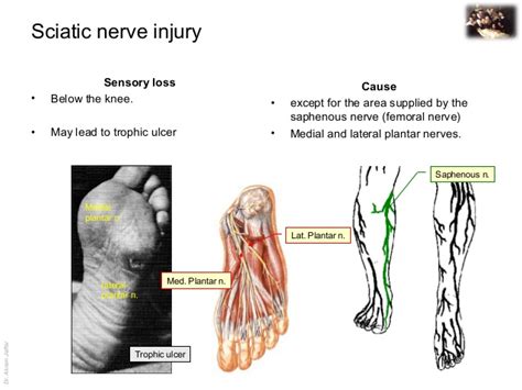 Applied anatomy sciatic nerve injury