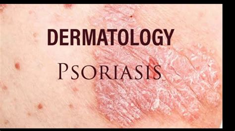 Dermatology - Psoriasis - YouTube