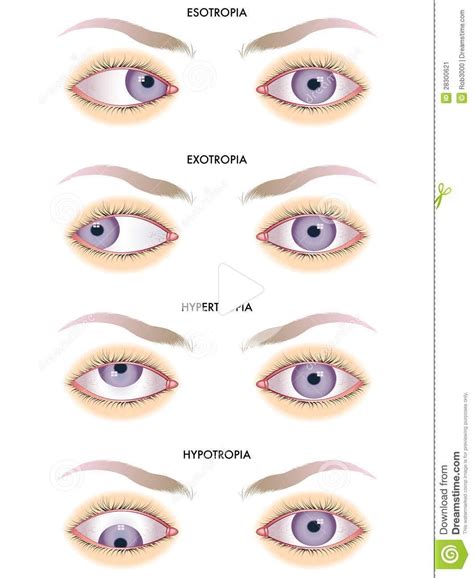 strabismus stock vector illustration of esotropia convergent 28300621 in 2020 medical