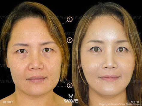 Transformation Gallery Wave Plastic Surgery