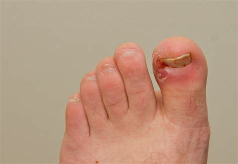 Ingrowing Toe Nail Consultation And Removal Treatment