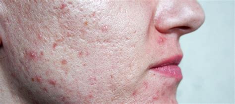 Relation Between Large Pores Acne And Oily Skin Reequil