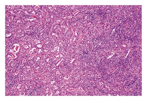 Histology Of Synovial Sarcoma And Immunohistochemical Staining For