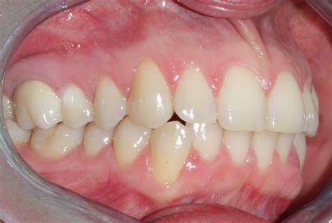 Apiñamiento Dental Antes Y Después Con Invisaling Ortodoncia Ac